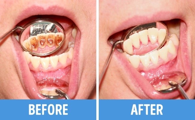 8 common mistakes in dental care Picture 6