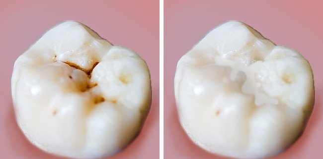 8 common mistakes in dental care Picture 9