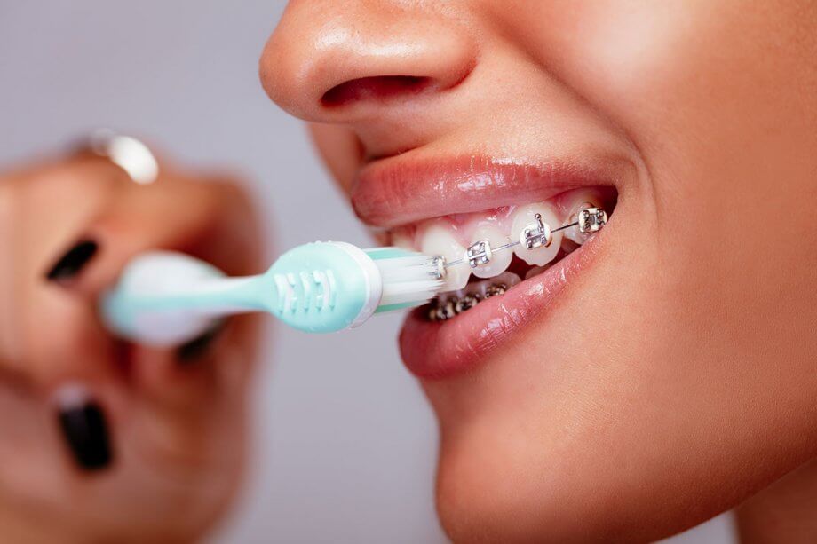 Braces & Mistakes in oral hygiene when braces Picture 3
