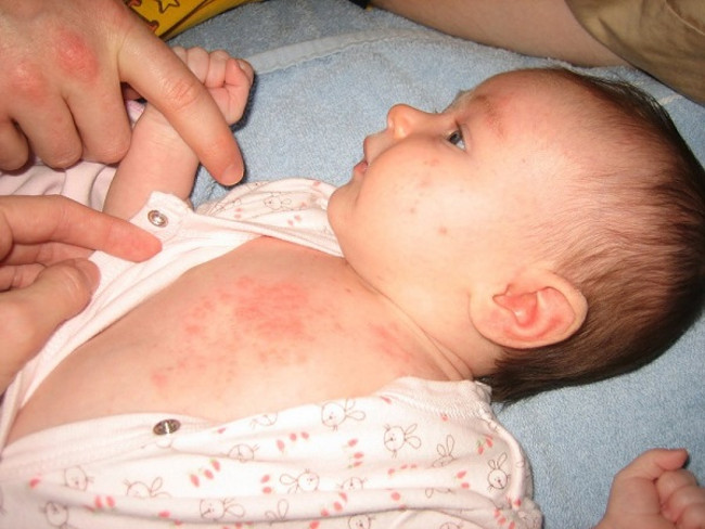 10 common diseases in children in the fall, symptoms and prevention Picture 3
