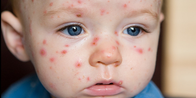 10 common diseases in children in the fall, symptoms and prevention Picture 9