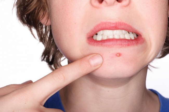 10 great uses of Aspirin may not be known Picture 1