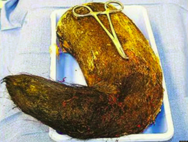 20 types of strange objects discovered in the human body make you 'floaters' Picture 13