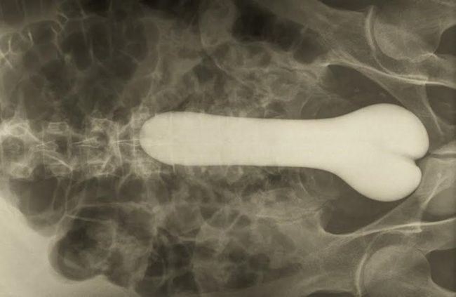 20 types of strange objects discovered in the human body make you 'floaters' Picture 15
