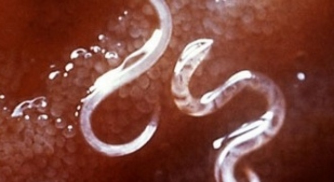 20 types of strange objects discovered in the human body make you 'floaters' Picture 19