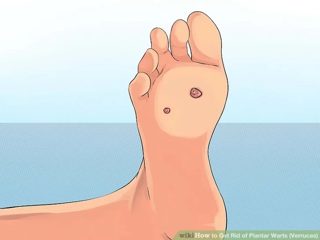 3 methods that treat permanent foot warts that are simple Picture 12