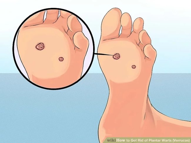 3 methods that treat permanent foot warts that are simple Picture 13