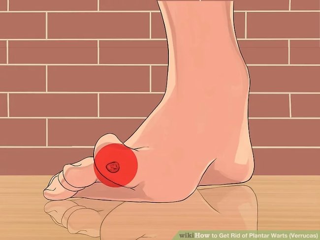 3 methods that treat permanent foot warts that are simple Picture 14