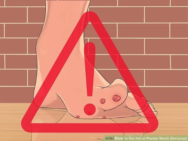 3 methods that treat permanent foot warts that are simple Picture 15