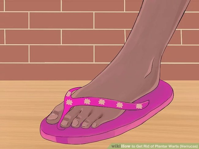 3 methods that treat permanent foot warts that are simple Picture 16