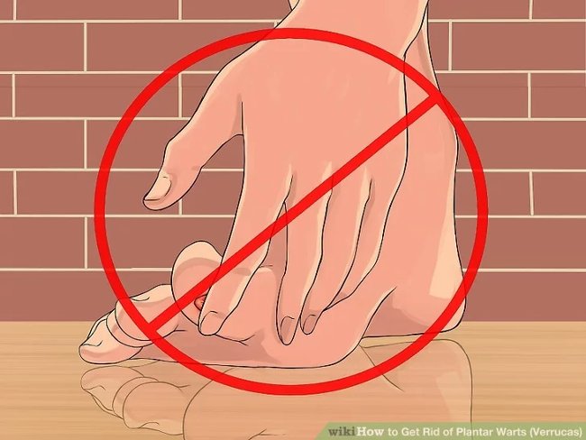 3 methods that treat permanent foot warts that are simple Picture 17