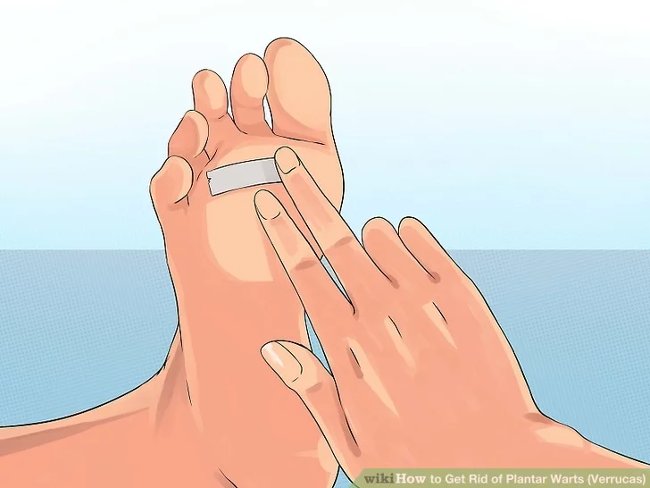 3 methods that treat permanent foot warts that are simple Picture 4