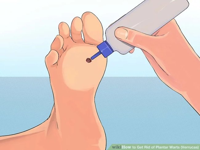 3 methods that treat permanent foot warts that are simple Picture 5