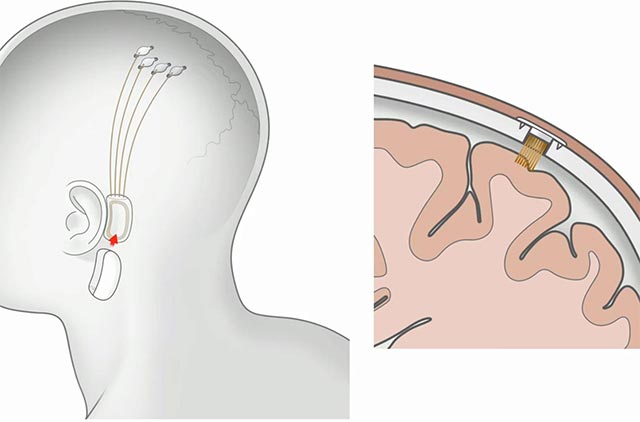 5 big questions about technology that connects the brain that Elon Musk is developing in Neuralink, transcendence or a dark script? Picture 6