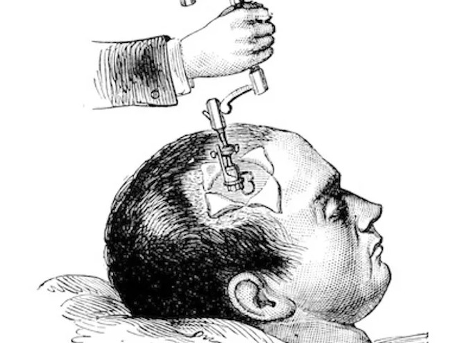 7 scary healing methods still apply today Picture 8