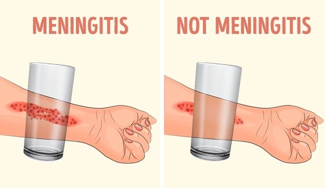 8 signs of childhood meningitis that parents should pay attention to Picture 8