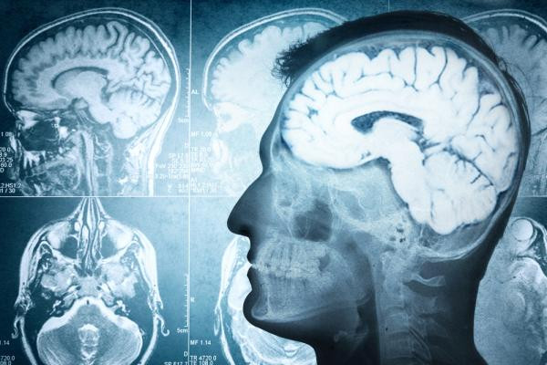 Alzheimer's can help treat patients with brain injury Picture 1