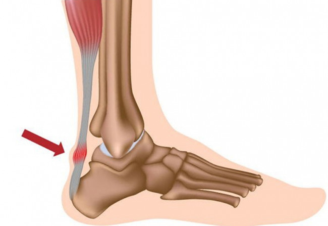 Can wearing high heels get cancer? Picture 2