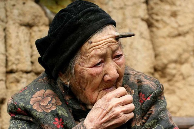 Cases of superfluous body parts in the world Picture 2