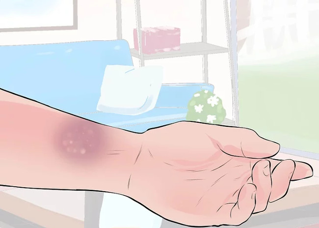 Distinguish between wrist sprains and wrist fractures Picture 4