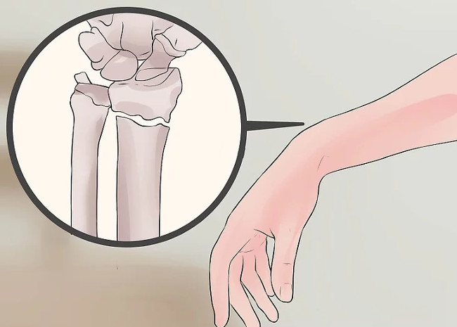 Distinguish between wrist sprains and wrist fractures Picture 6