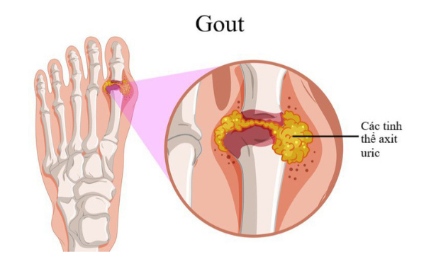 Distinguish from acute, chronic gout and gout disease Picture 1