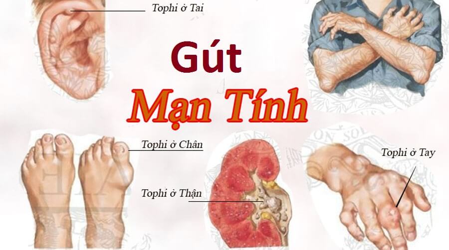 Distinguish from acute, chronic gout and gout disease Picture 4