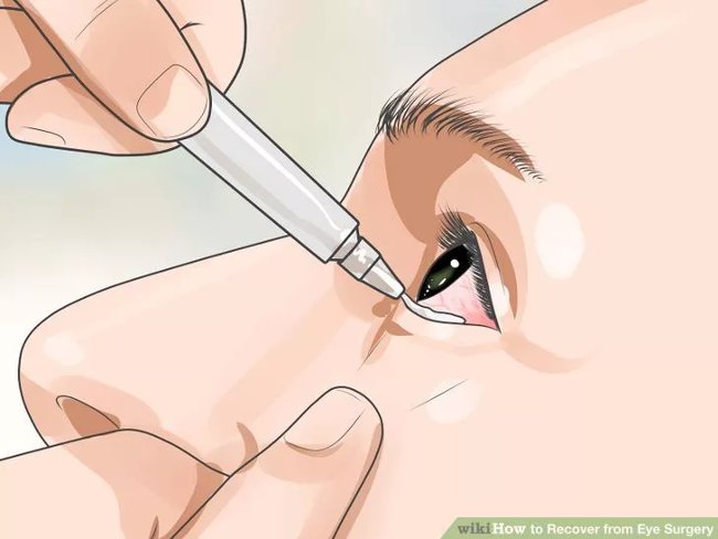 Eye care method properly after surgery Picture 15