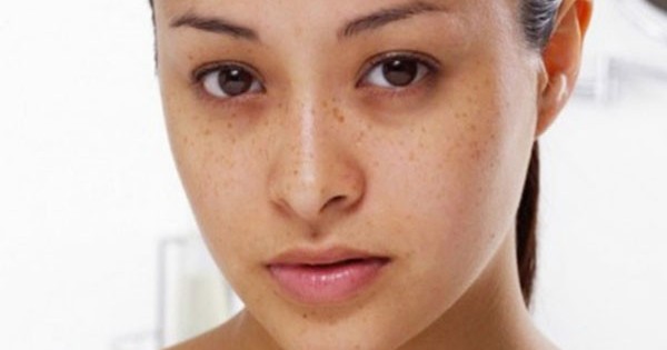 Eyes dark circles is a manifestation of what disease? Treatment of blurred vision at home okay? Picture 2