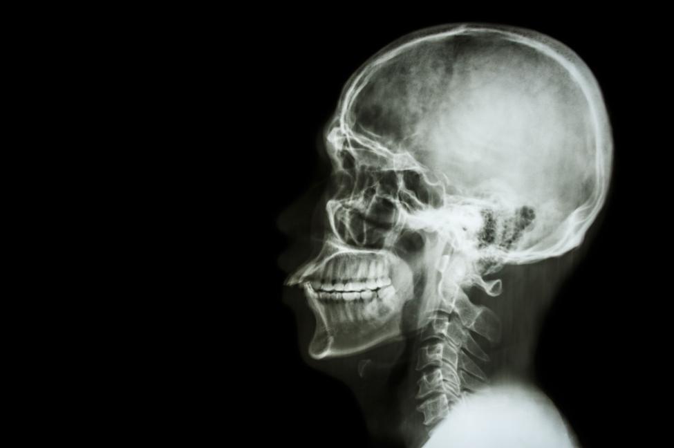 Finding a new substance capable of skull regeneration