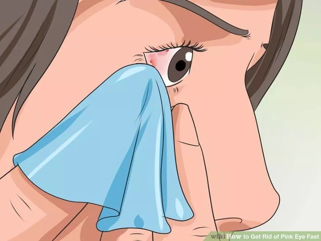 How to cure pinkeye quickly and effectively Picture 4