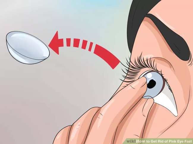 How to cure pinkeye quickly and effectively Picture 7