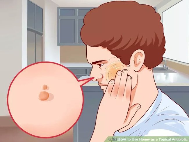 How to heal wounds quickly and effectively with honey Picture 8