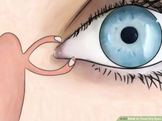 How to prevent and treat dry eyes effectively Picture 6