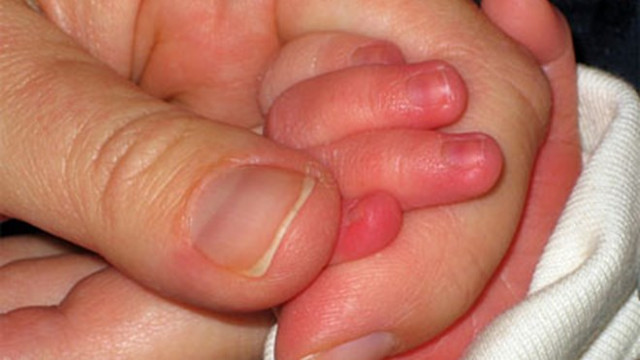 How to prevent and treat limbs in the winter Picture 2