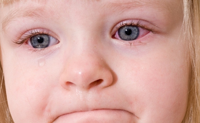 How to prevent and treat pinkeye Picture 1