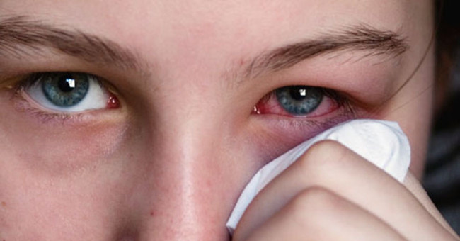 How to prevent and treat pinkeye Picture 2