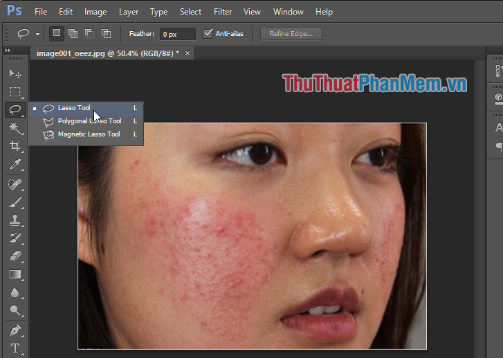 How to remove acne with Photoshop Picture 2