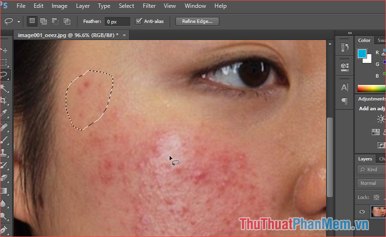 How to remove acne with Photoshop Picture 3