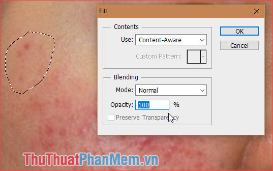 How to remove acne with Photoshop Picture 4