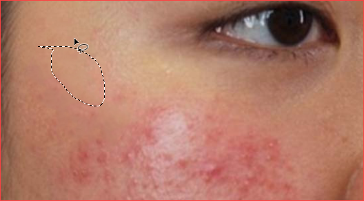 How to remove acne with Photoshop Picture 5