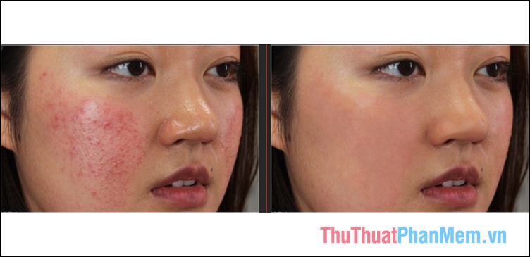 How to remove acne with Photoshop Picture 9