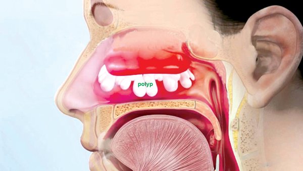 How to treat runny nose fast, safely and effectively at home? Picture 3