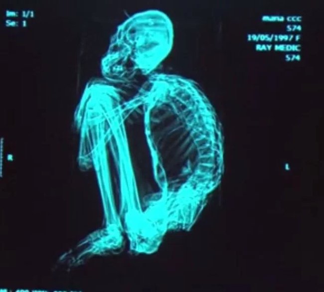 Is the 'alien skeleton' found in Peru true? Picture 4
