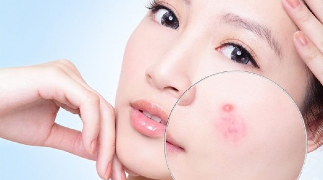 It turns out that many acne sufferers will get older Picture 1