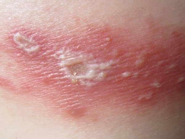 Mistakes caused the wound due to ants burning three long burning chambers Picture 2