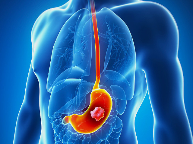 Often heartburn can be a sign of stomach cancer Picture 1