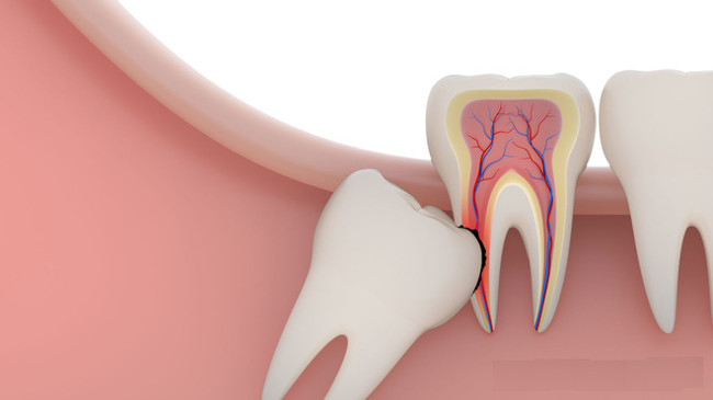 Recognize the symptoms of wisdom teeth for better coping Picture 3