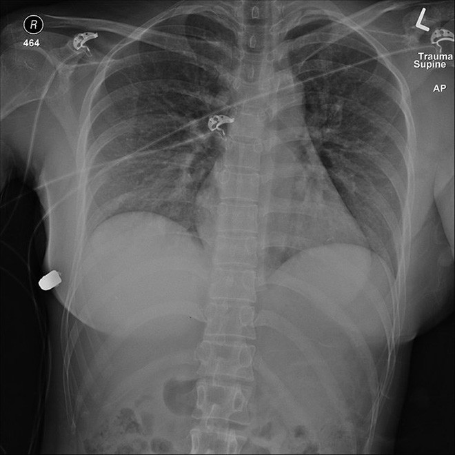 Silicone breast pads deflect bullets, saving Canadian girls' lives Picture 2