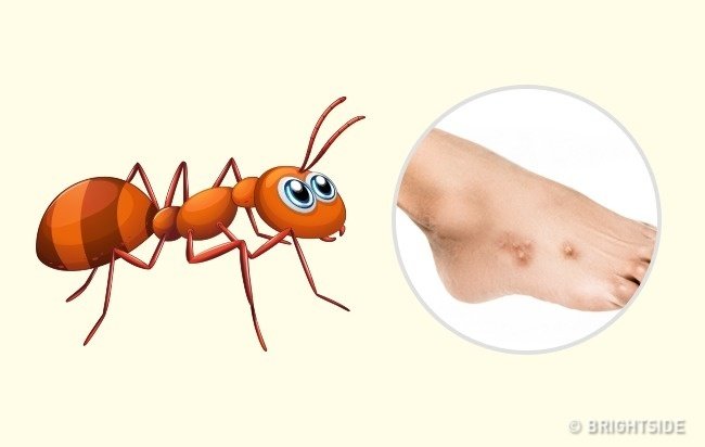 Simple way to 'identify' insect bites Picture 7